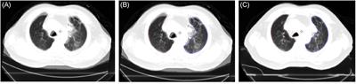 A novel tool to evaluate and quantify radiation pneumonitis: A retrospective analysis of correlation of dosimetric parameters with volume of pneumonia patch